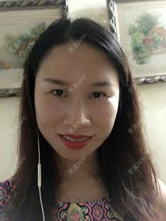 更美 - 玲妹妹的蜕变的自体脂肪隆鼻经验 | 全自体耳软骨隆鼻 | 鼻部整形 | 自体脂肪隆鼻 | 重庆