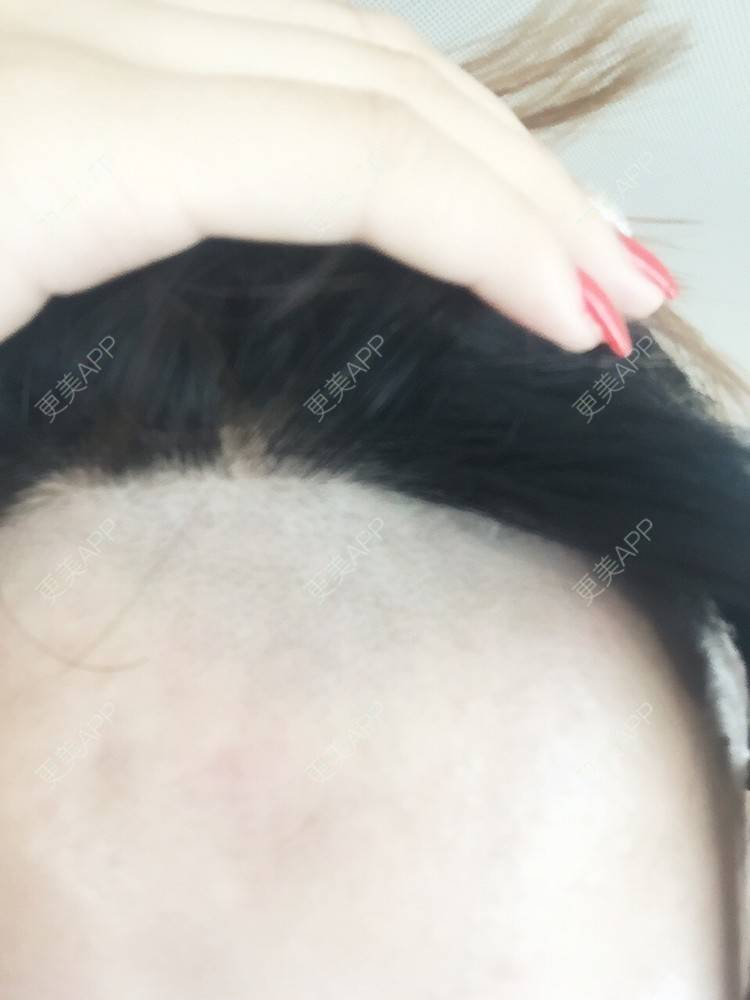 更美 - 毛猴儿的激光脱毛经验 | 美购日记 | 激光脱毛 | 荆门