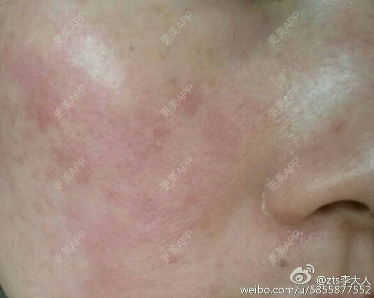 更美 - zts李大人的果酸焕肤经验 | 果酸祛痘 | 果酸焕肤 | 皮肤美容 | 北京