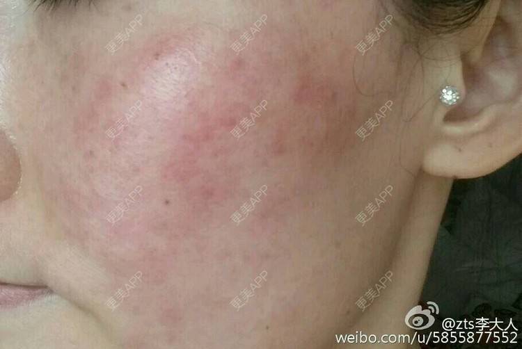 更美 - zts李大人的果酸焕肤经验 | 果酸祛痘 | 果酸焕肤 | 皮肤美容 | 北京