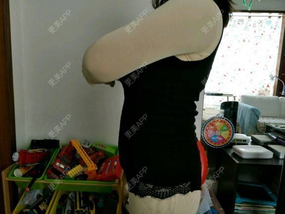 更美 - 樱桃的滋味儿的经验 | 美购日记 | 上臂吸脂 | 北京
