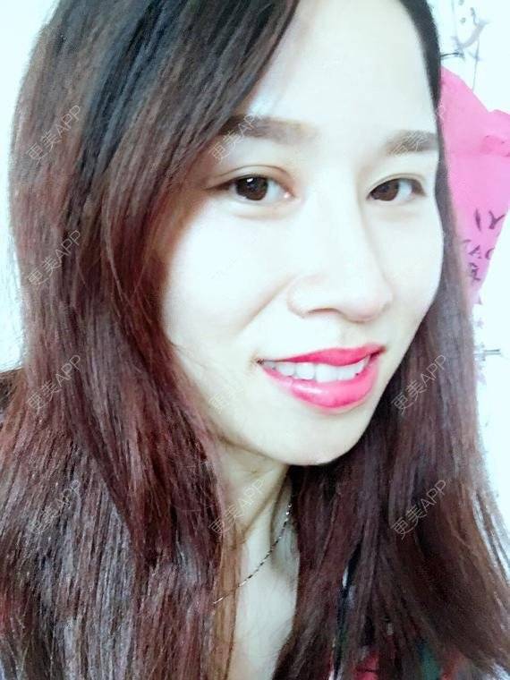 更美 - 玲妹妹的蜕变的自体脂肪隆鼻经验 | 全自体耳软骨隆鼻 | 鼻部整形 | 自体脂肪隆鼻 | 重庆