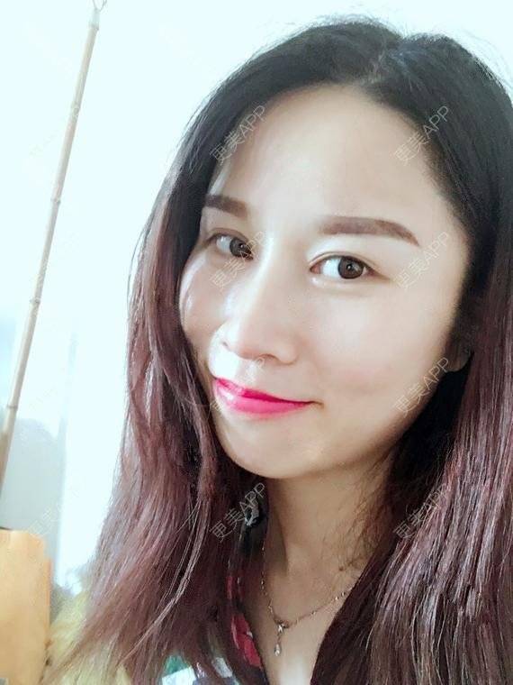 更美 - 玲妹妹的蜕变的自体脂肪隆鼻经验 | 全自体耳软骨隆鼻 | 鼻部整形 | 自体脂肪隆鼻 | 重庆