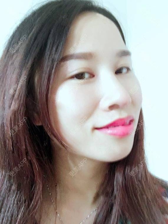 更美 - 玲妹妹的蜕变的自体脂肪隆鼻经验 | 全自体耳软骨隆鼻 | 鼻部整形 | 自体脂肪隆鼻 | 重庆