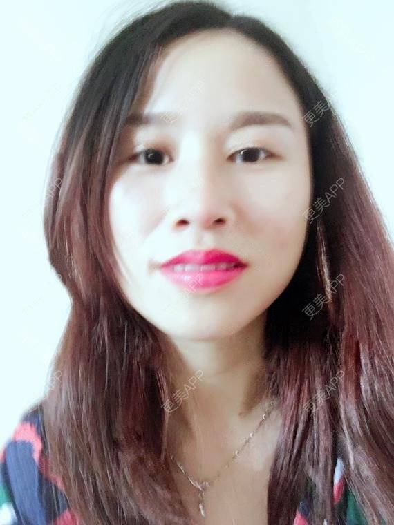 更美 - 玲妹妹的蜕变的自体脂肪隆鼻经验 | 全自体耳软骨隆鼻 | 鼻部整形 | 自体脂肪隆鼻 | 重庆