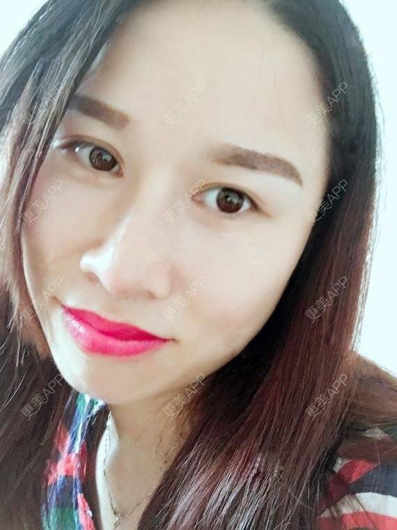 更美 - 玲妹妹的蜕变的自体脂肪隆鼻经验 | 全自体耳软骨隆鼻 | 鼻部整形 | 自体脂肪隆鼻 | 重庆