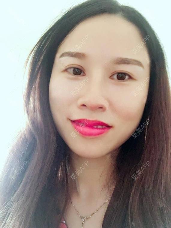 更美 - 玲妹妹的蜕变的自体脂肪隆鼻经验 | 全自体耳软骨隆鼻 | 鼻部整形 | 自体脂肪隆鼻 | 重庆