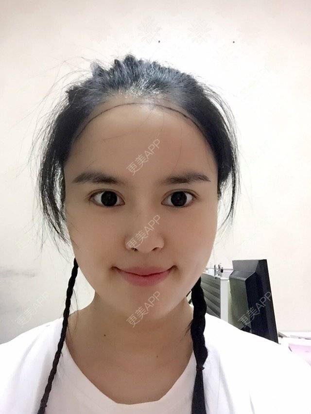 更美 - 15*******85的经验 | 植眉毛 | 美购日记 | 南昌 | 植发际线