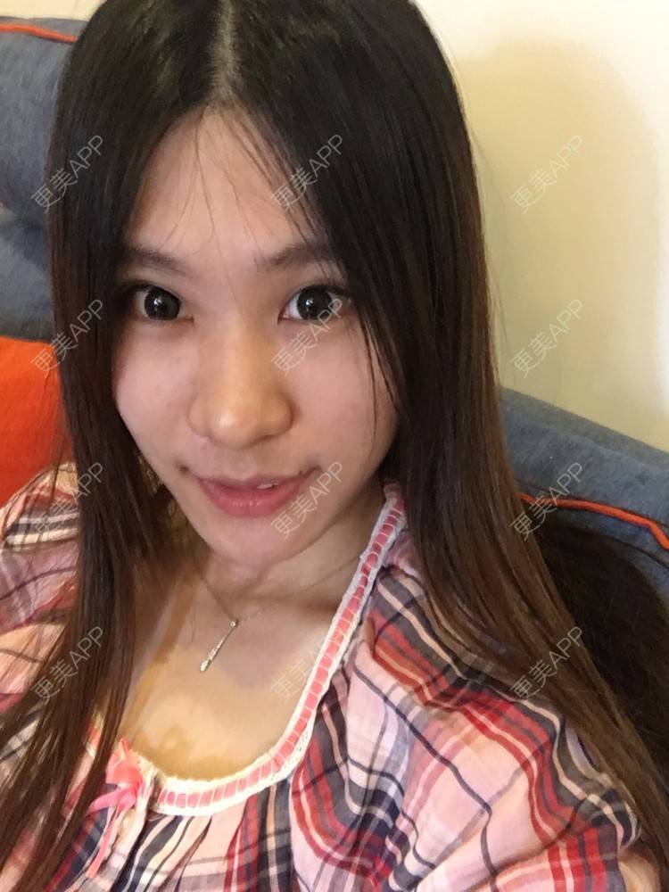 更美 - 圆又圆丁的玻尿酸经验 | 玻尿酸法令纹 | 美购日记 | 玻尿酸 | 上海