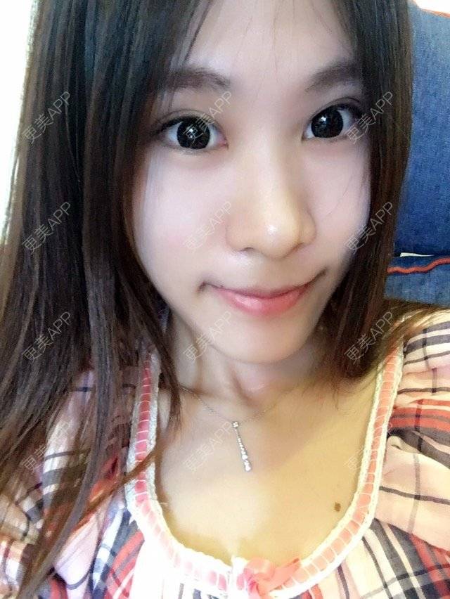 更美 - 圆又圆丁的玻尿酸经验 | 玻尿酸法令纹 | 美购日记 | 玻尿酸 | 上海