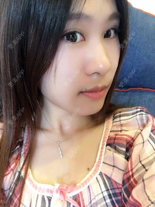 更美 - 圆又圆丁的玻尿酸经验 | 玻尿酸法令纹 | 美购日记 | 玻尿酸 | 上海