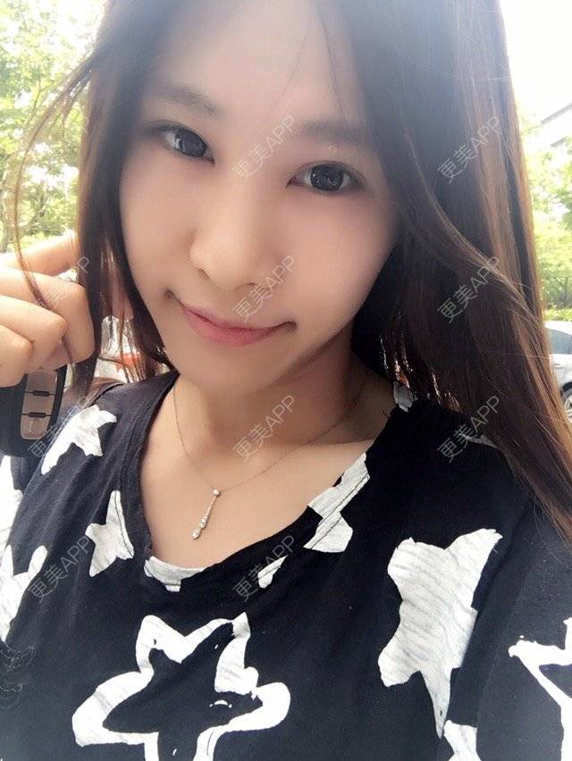 更美 - 圆又圆丁的玻尿酸经验 | 玻尿酸法令纹 | 美购日记 | 玻尿酸 | 上海