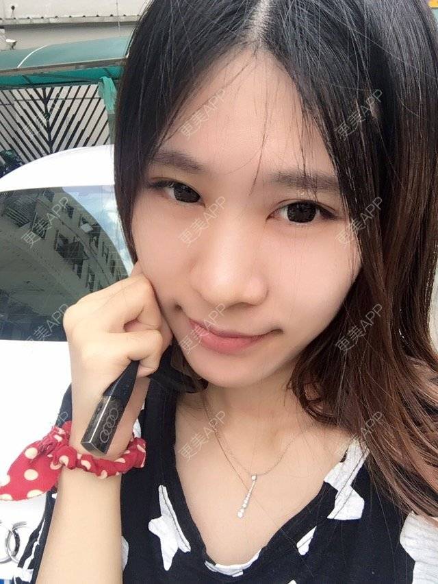 更美 - 圆又圆丁的玻尿酸经验 | 玻尿酸法令纹 | 美购日记 | 玻尿酸 | 上海