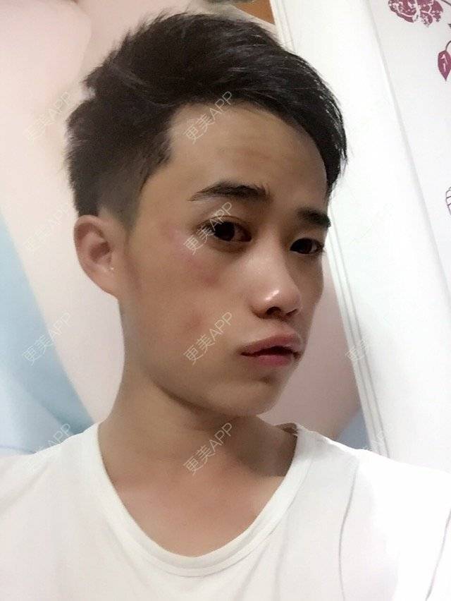 更美 - う七色光つ的激光淡斑经验 | 激光淡斑 | 激光雀斑 | 呼和浩特 | 美白嫩肤