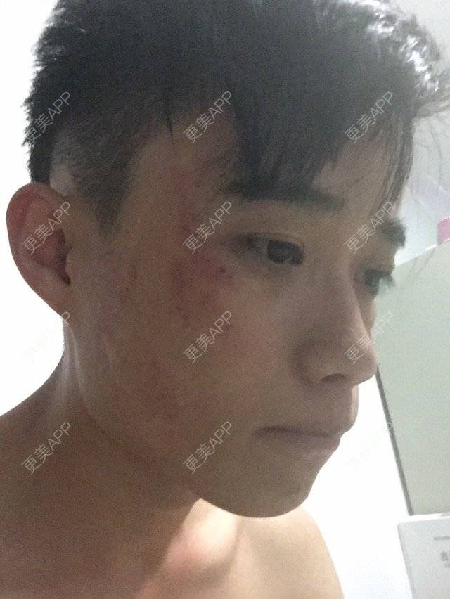 更美 - う七色光つ的激光淡斑经验 | 激光淡斑 | 激光雀斑 | 呼和浩特 | 美白嫩肤