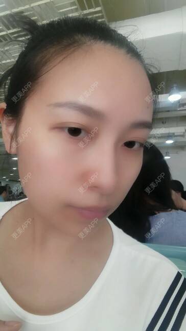 更美 - 更美用户cobFUZ4PJO的瘦脸除皱经验 | 美购日记 | 瘦脸除皱 | 瘦脸针术后 | 重庆