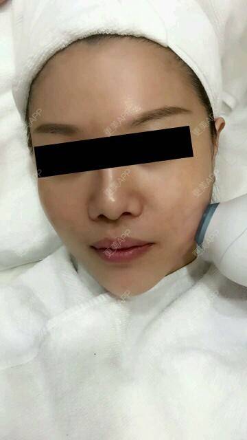 更美 - 更美用户zy42NoNP3r的热拉提经验 | 热拉提 | 超声紧致 | 面部改善 | 成都