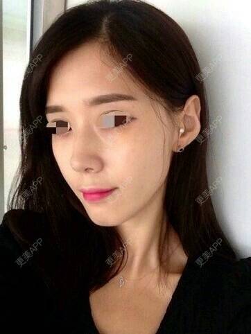 更美 - 更美用户r1bUucir9I的玻尿酸经验 | 玻尿酸 | 玻尿酸 | 广州