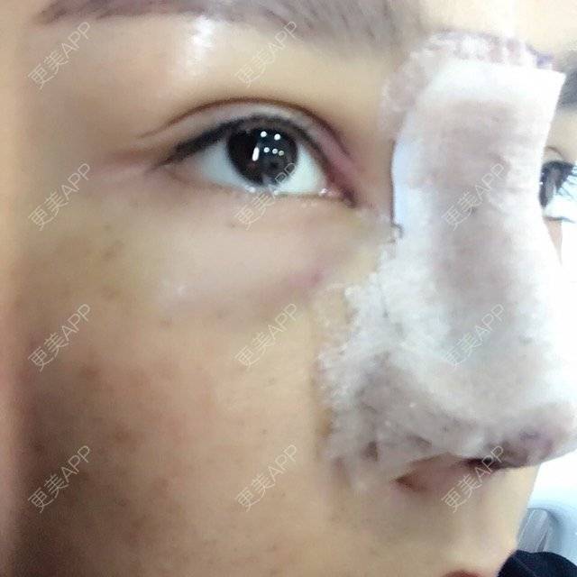 更美 - 涵mm的隆鼻经验 | 美购日记 | 宽鼻缩窄 | 膨体鼻综合 | 鼻假体取出 | 隆鼻 | 深圳