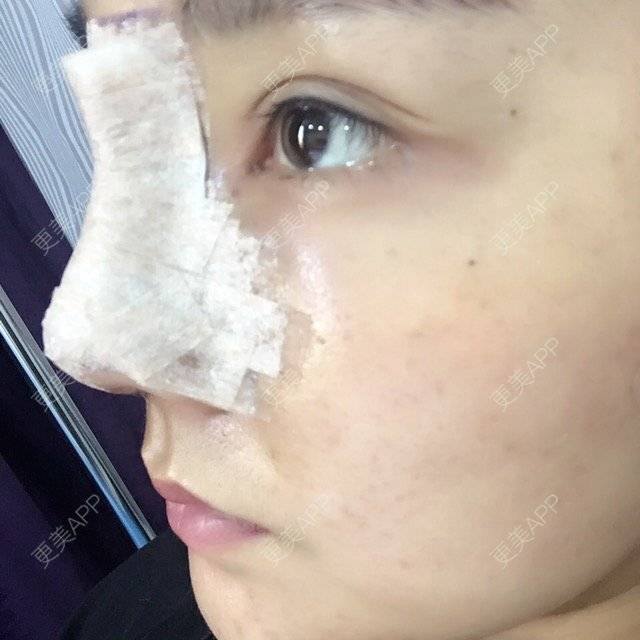 更美 - 涵mm的隆鼻经验 | 美购日记 | 宽鼻缩窄 | 膨体鼻综合 | 鼻假体取出 | 隆鼻 | 深圳