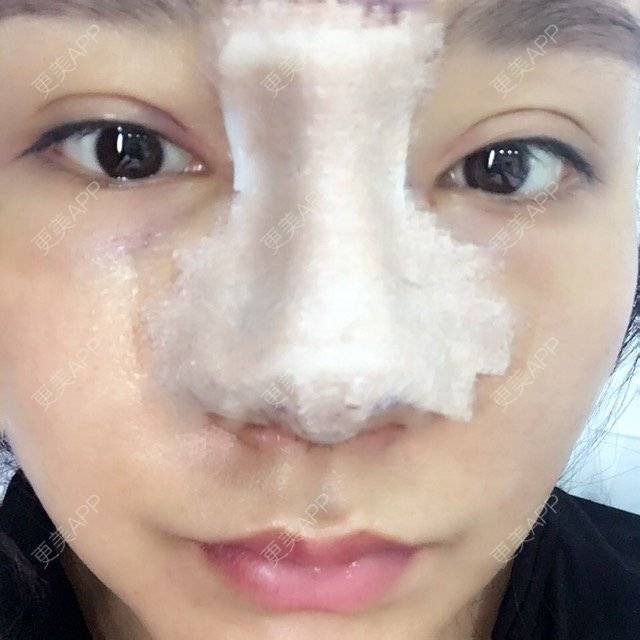 更美 - 涵mm的隆鼻经验 | 美购日记 | 宽鼻缩窄 | 膨体鼻综合 | 鼻假体取出 | 隆鼻 | 深圳