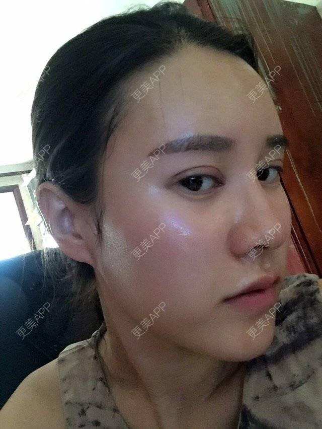 更美 - 福岁的祛眼袋经验 | 美购日记 | 祛眼袋 | 内路去眼袋 | 北京