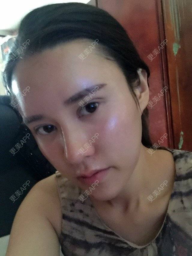 更美 - 福岁的祛眼袋经验 | 美购日记 | 祛眼袋 | 内路去眼袋 | 北京