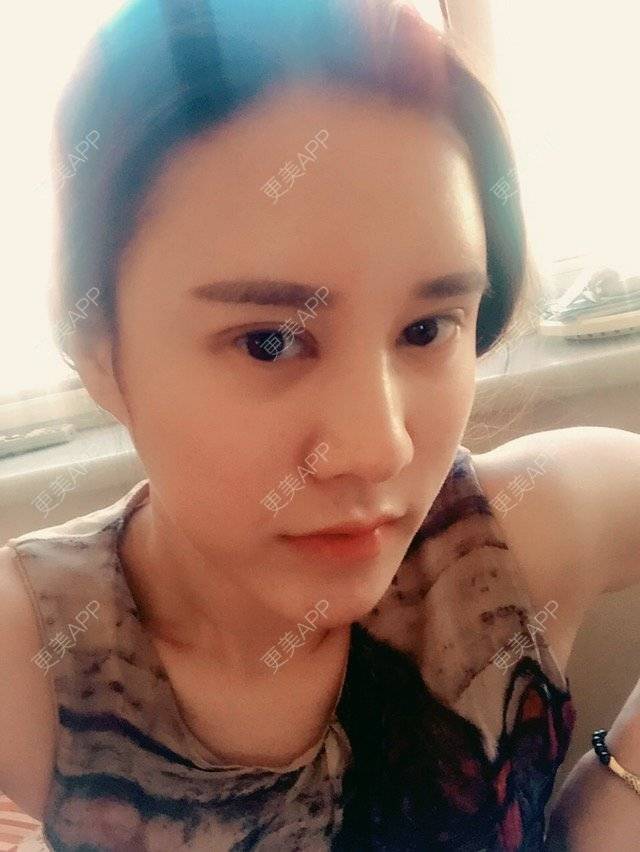 更美 - 福岁的祛眼袋经验 | 美购日记 | 祛眼袋 | 内路去眼袋 | 北京