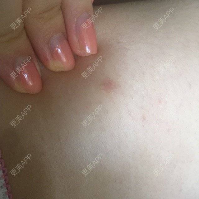 更美 - 是啊没错是什么的经验 | 脂肪填充面部 | 美购日记 | 疤痕疙瘩 | 沈阳