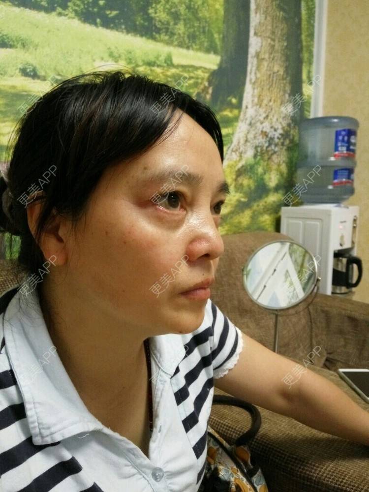 更美 - 更美用户0BUephUhtV的眼部护理经验 | 眼部护理 | 除皱 | 成都