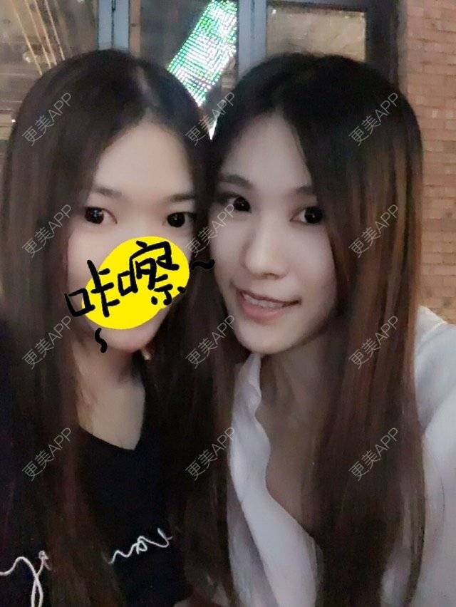 更美 - 圆又圆丁的玻尿酸经验 | 玻尿酸法令纹 | 美购日记 | 玻尿酸 | 上海