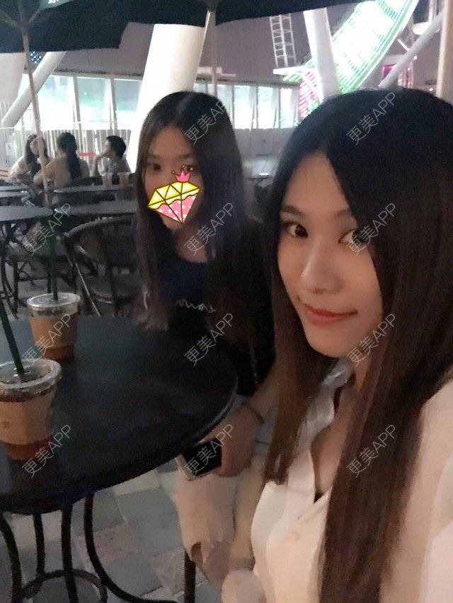 更美 - 圆又圆丁的玻尿酸经验 | 玻尿酸法令纹 | 美购日记 | 玻尿酸 | 上海