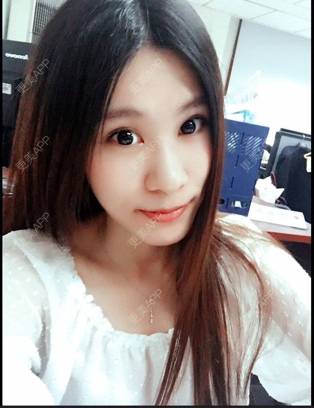 更美 - 圆又圆丁的玻尿酸经验 | 玻尿酸法令纹 | 美购日记 | 玻尿酸 | 上海