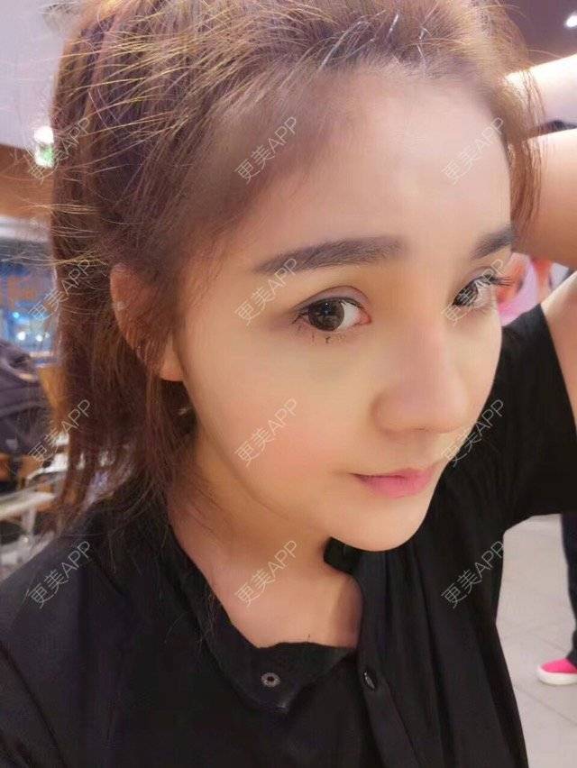 更美 - 涵mm的隆鼻经验 | 美购日记 | 宽鼻缩窄 | 膨体鼻综合 | 假体隆鼻修复术 | 隆鼻 | 深圳