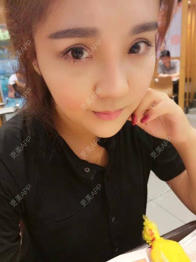 更美 - 涵mm的隆鼻经验 | 美购日记 | 宽鼻缩窄 | 膨体鼻综合 | 假体隆鼻修复术 | 隆鼻 | 深圳