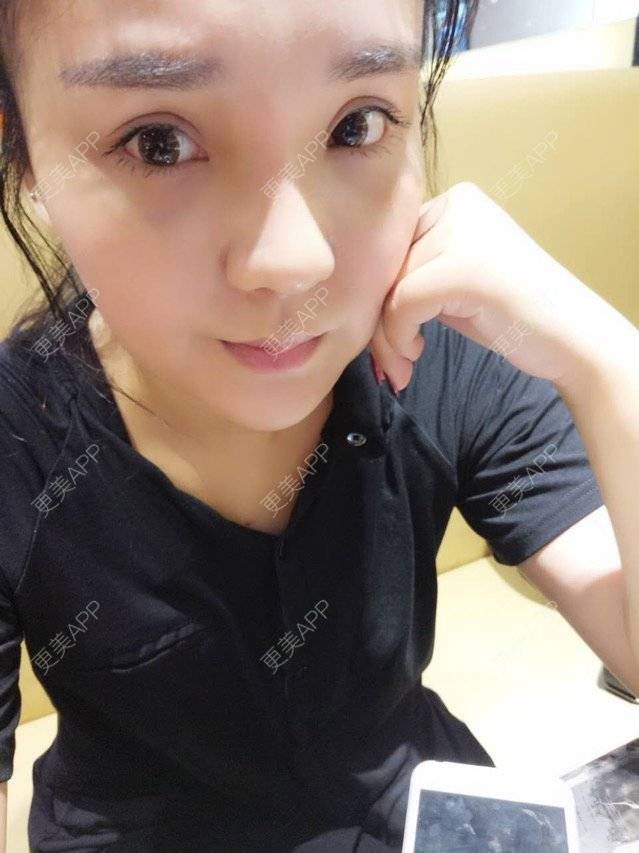 更美 - 涵mm的隆鼻经验 | 美购日记 | 宽鼻缩窄 | 膨体鼻综合 | 假体隆鼻修复术 | 隆鼻 | 深圳