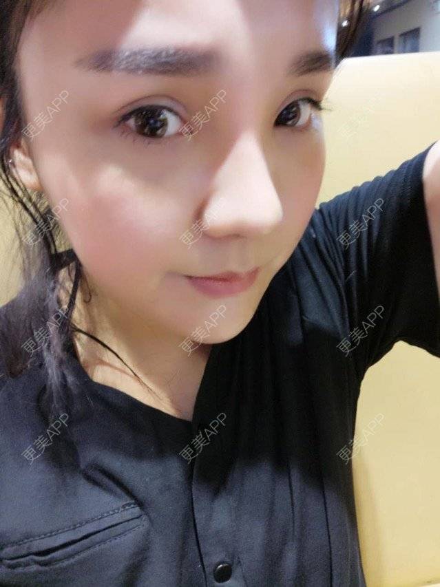 更美 - 涵mm的隆鼻经验 | 美购日记 | 宽鼻缩窄 | 膨体鼻综合 | 假体隆鼻修复术 | 隆鼻 | 深圳