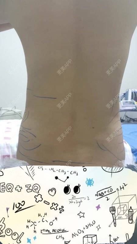 更美 - 瑗瑗要么瘦要么死的腰腹吸脂经验 | 腰腹部吸脂 | 吸脂瘦腰腹 | 腰腹吸脂 | 重庆