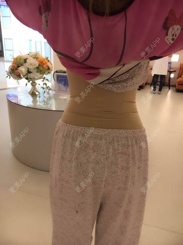 更美 - 瑗瑗要么瘦要么死的腰腹吸脂经验 | 腰腹部吸脂 | 吸脂瘦腰腹 | 腰腹吸脂 | 重庆