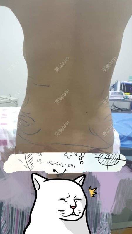 更美 - 瑗瑗要么瘦要么死的腰腹吸脂经验 | 腰腹部吸脂 | 吸脂瘦腰腹 | 腰腹吸脂 | 重庆
