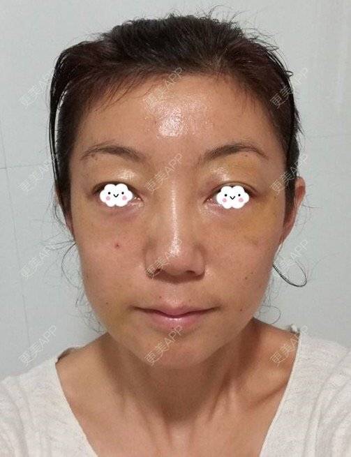 更美 - 喵喵小饼干的自体脂肪全面部填充经验 | 上海 | 自体脂肪填充眼窝 | 自体脂肪填充鼻唇沟 | 自体脂肪全面部填充 | 自体脂肪填法令纹