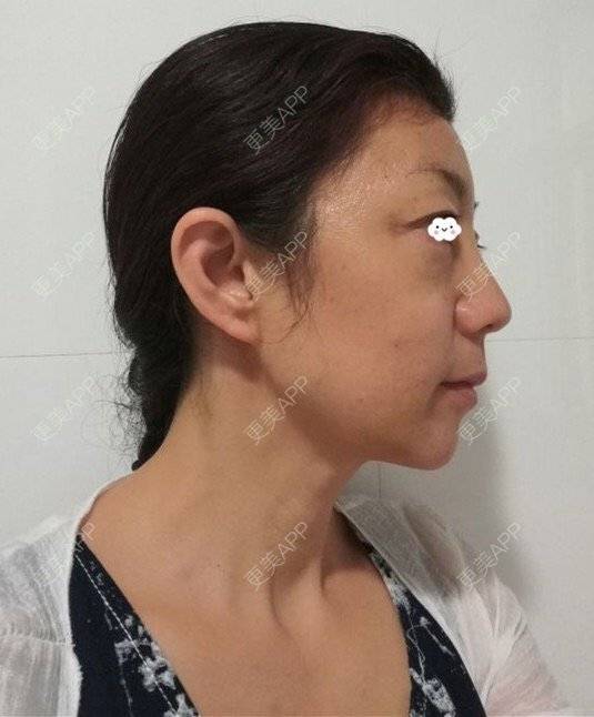 更美 - 喵喵小饼干的自体脂肪全面部填充经验 | 上海 | 自体脂肪填充眼窝 | 自体脂肪填充鼻唇沟 | 自体脂肪全面部填充 | 自体脂肪填法令纹