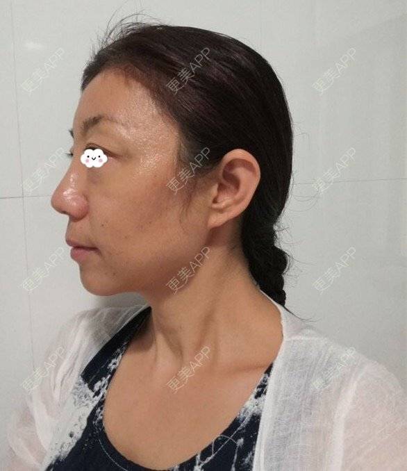 更美 - 喵喵小饼干的自体脂肪全面部填充经验 | 上海 | 自体脂肪填充眼窝 | 自体脂肪填充鼻唇沟 | 自体脂肪全面部填充 | 自体脂肪填法令纹