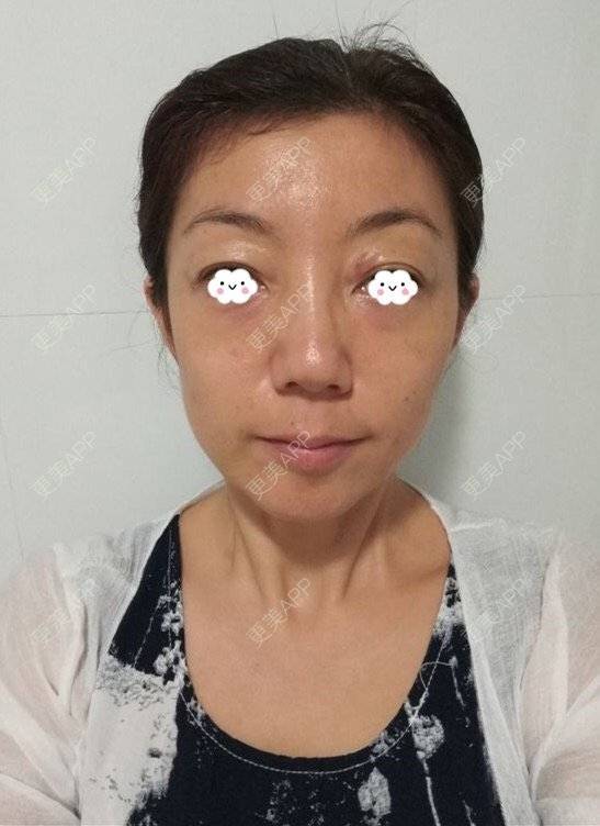 更美 - 喵喵小饼干的自体脂肪全面部填充经验 | 上海 | 自体脂肪填充眼窝 | 自体脂肪填充鼻唇沟 | 自体脂肪全面部填充 | 自体脂肪填法令纹