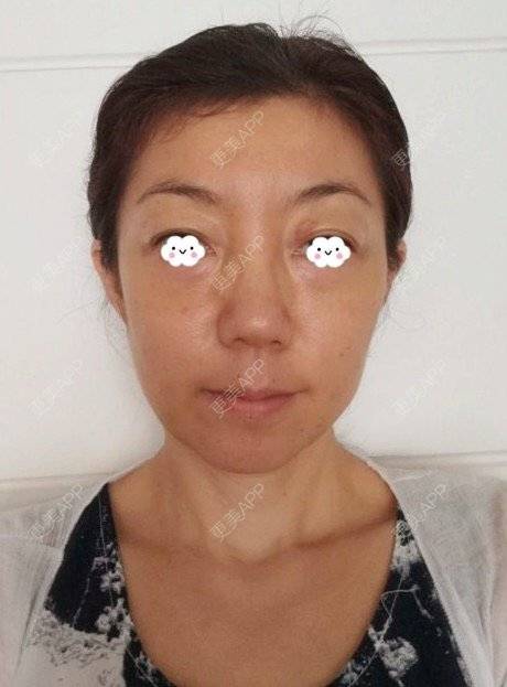 更美 - 喵喵小饼干的自体脂肪全面部填充经验 | 上海 | 自体脂肪填充眼窝 | 自体脂肪填充鼻唇沟 | 自体脂肪全面部填充 | 自体脂肪填法令纹