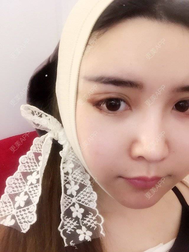 更美 - 素手白衣邢公子的颧骨内推经验 | 脸部轮廓 | 韩国隆胸 | 晒整容模板 | 颧骨内推 | 洛阳