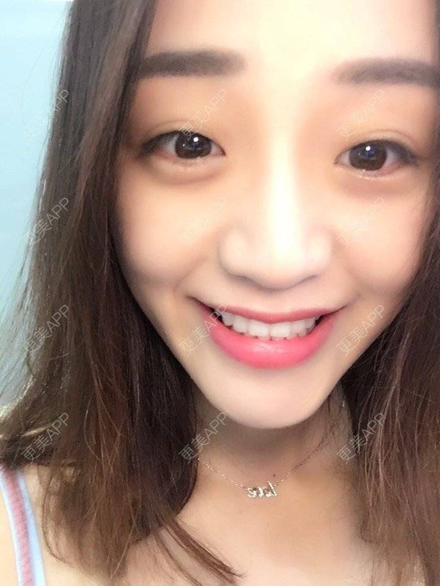 更美 - 损损的牙齿美白经验 | 白牙免费送 | 其他 | 冷光美白 | 美购日记 | 牙齿美白 | 冷光美白1 | 北京