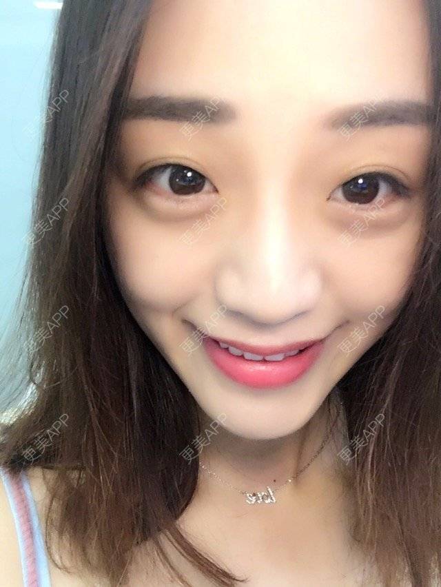 更美 - 损损的牙齿美白经验 | 白牙免费送 | 其他 | 冷光美白 | 美购日记 | 牙齿美白 | 冷光美白1 | 北京