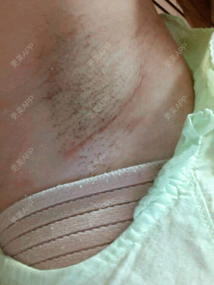 更美 - 傲娇的小妮子的假体隆胸经验 | 水滴形假体隆胸 | 大波 | 假体隆胸 | 韩国隆胸