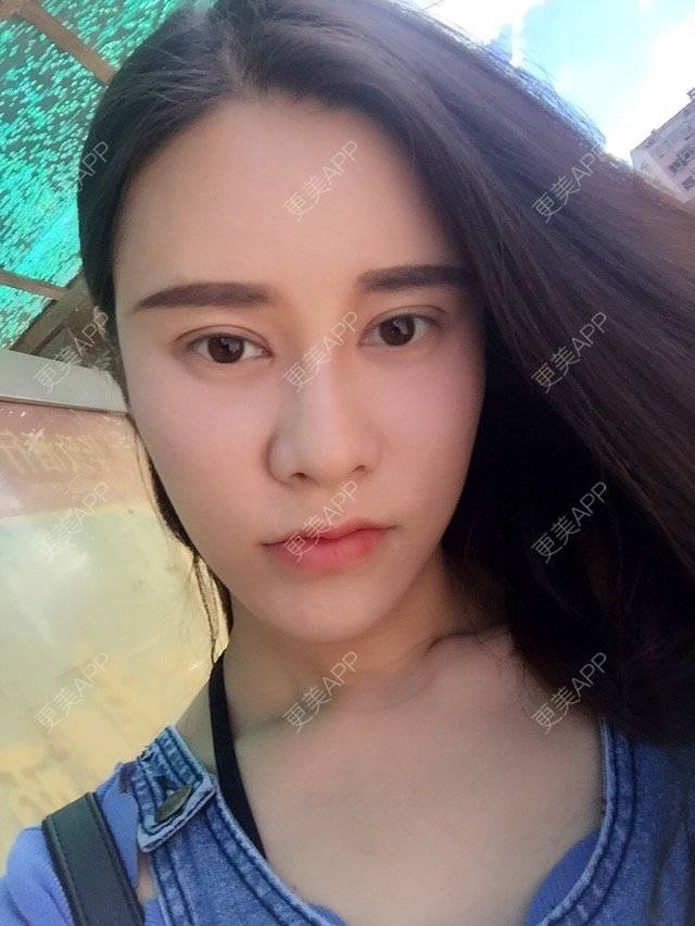 更美 - 福岁的祛眼袋经验 | 美购日记 | 祛眼袋 | 内路去眼袋 | 北京